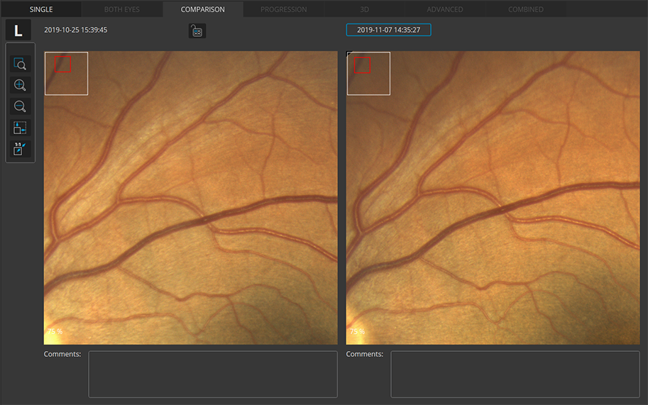 Fundus photo comparison view