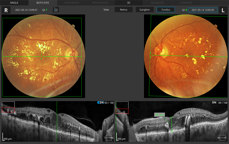 Retina 3D Both Eyes Fundus View