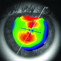 Corneal Topographers