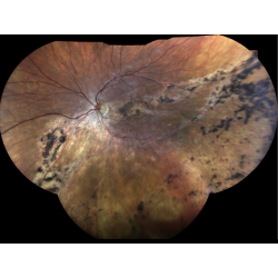 Widefield retinal camera